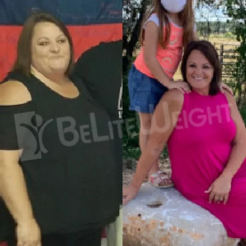 Metabolic Mini Gastric Bypass